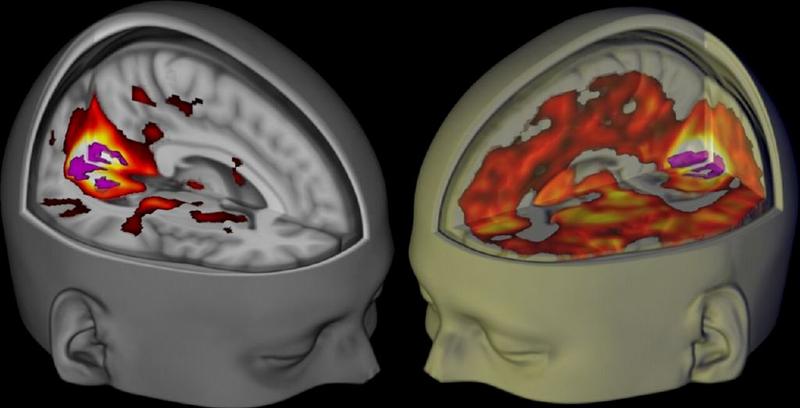 Scansione cerebrale con risonanza magnetica 